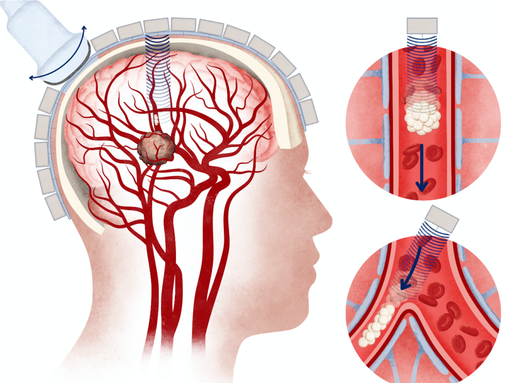 Implants and Catheters